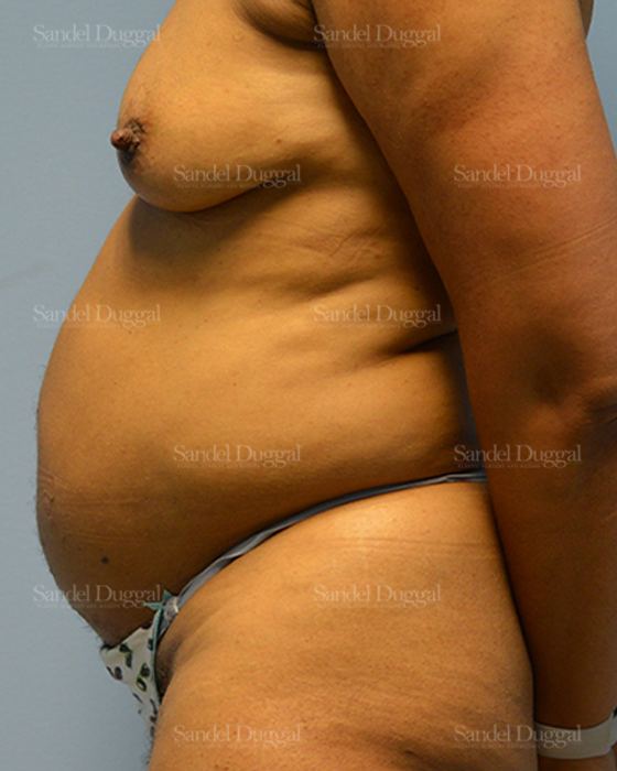 Tummy Tuck before, case 1510
