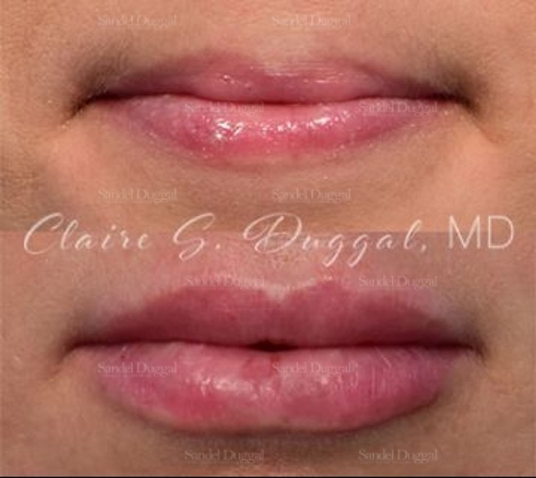 Lip Augmentation / Lip Lift before and after, case 4385