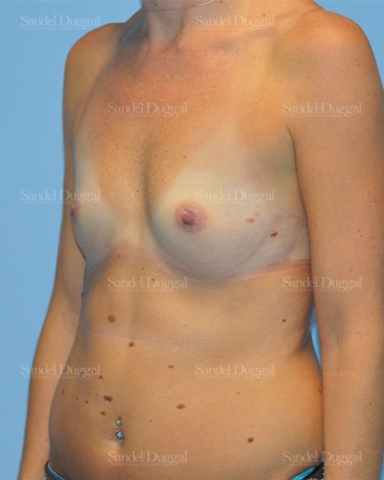 Breast Augmentation before, case 771