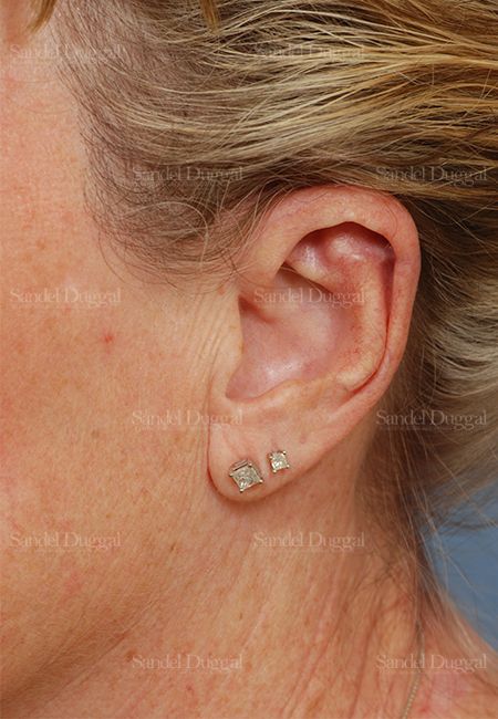 Scar Revision after, case 2570