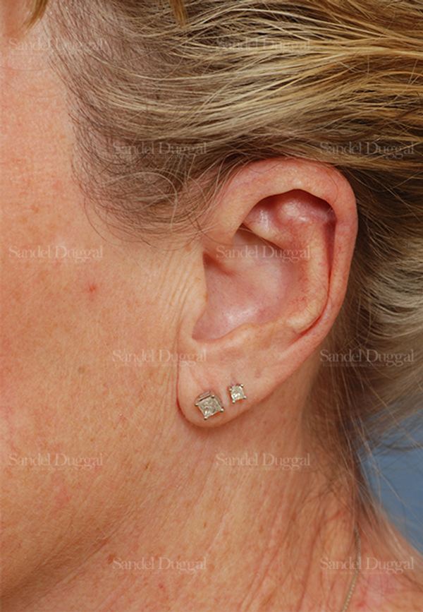 Scar Revision after, case 2570