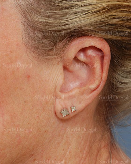 Scar Revision after, case 2570