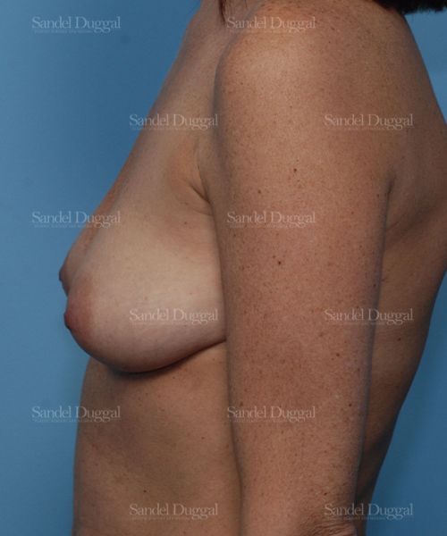 Breast Augmentation with Lift before, case 3435
