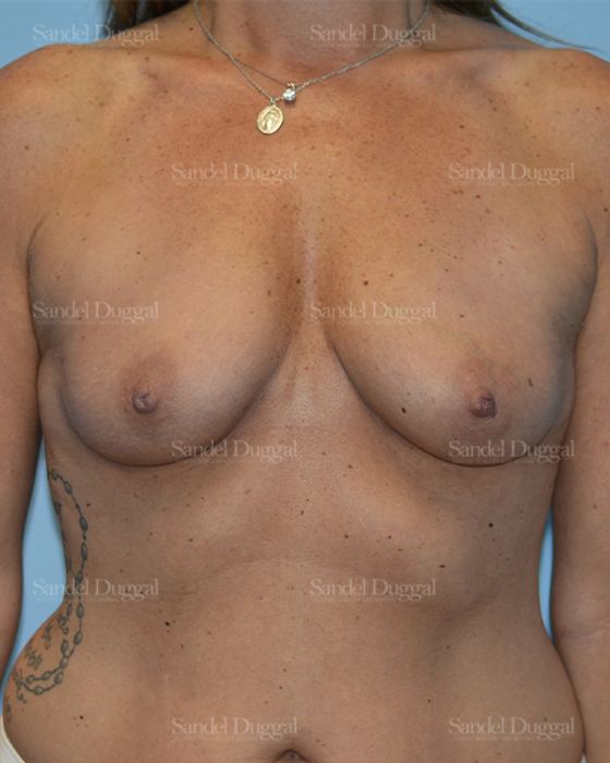 Breast Augmentation before, case 3185