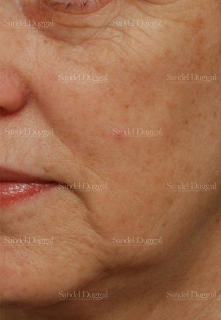 Laser Skin Resurfacing before, case 2978
