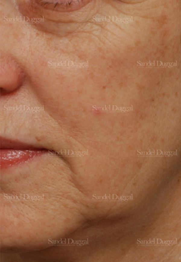 Laser Skin Resurfacing before, case 2978