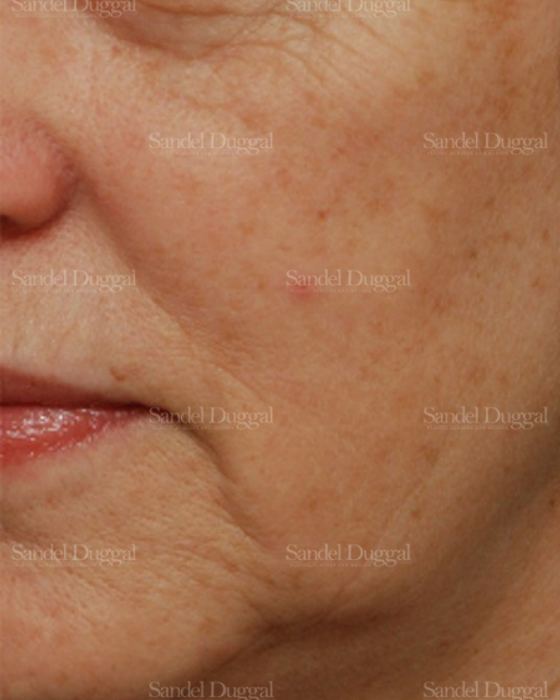 Laser Skin Resurfacing before, case 2978