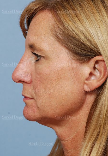 Rhinoplasty after, case 2918