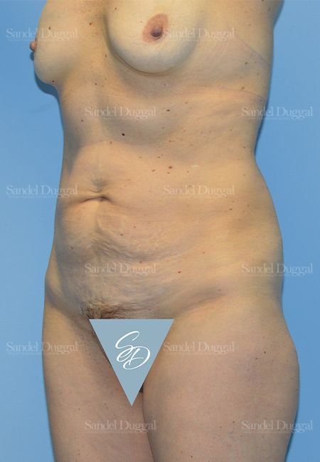 Mommy Makeover before, case 799