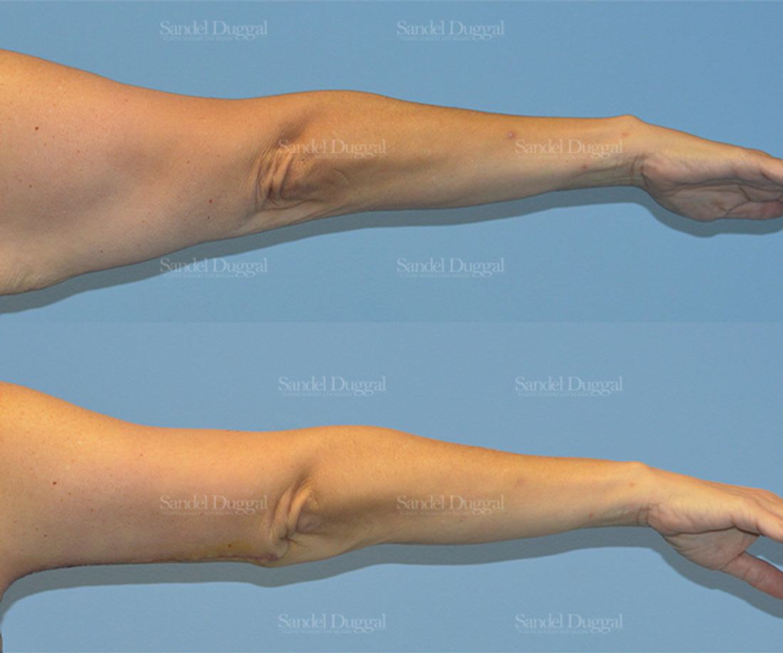 Brachioplasty before and after, case 2123