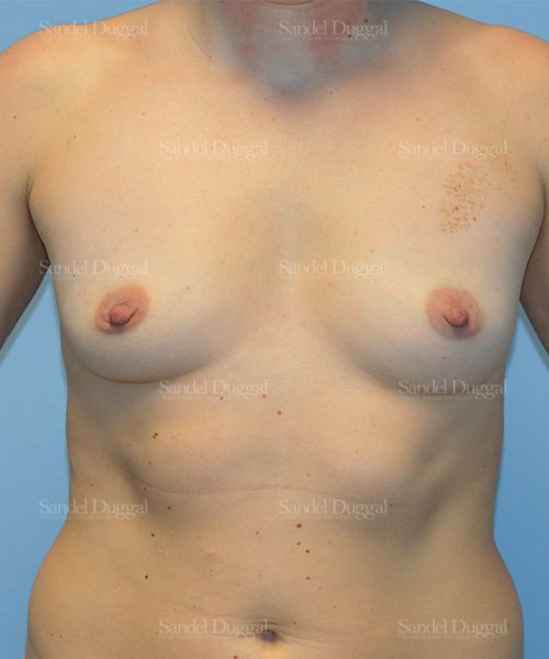 Breast Augmentation before, case 3122
