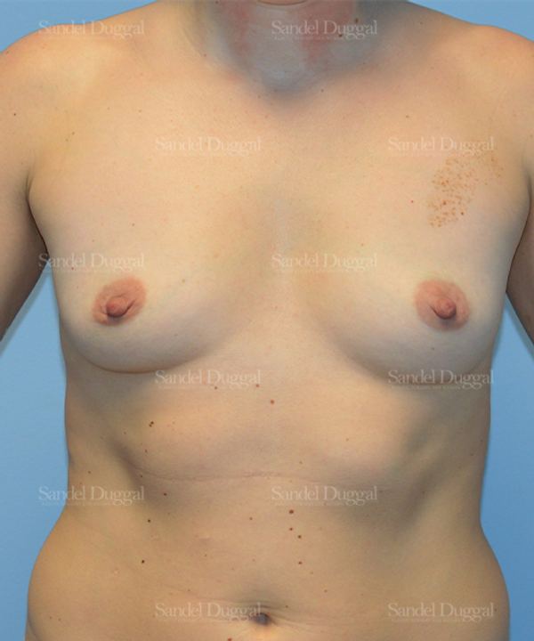 Breast Augmentation before, case 3122