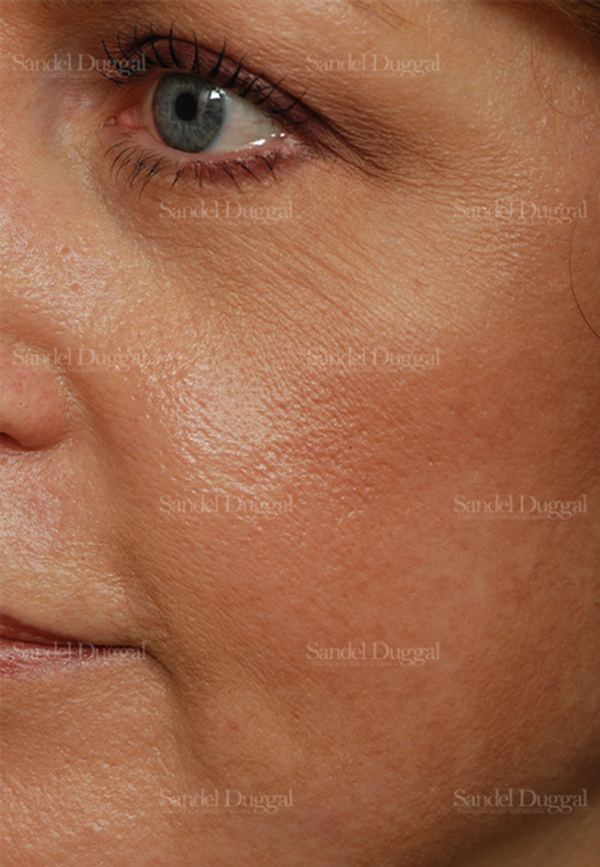 Laser Skin Resurfacing after, case 2923