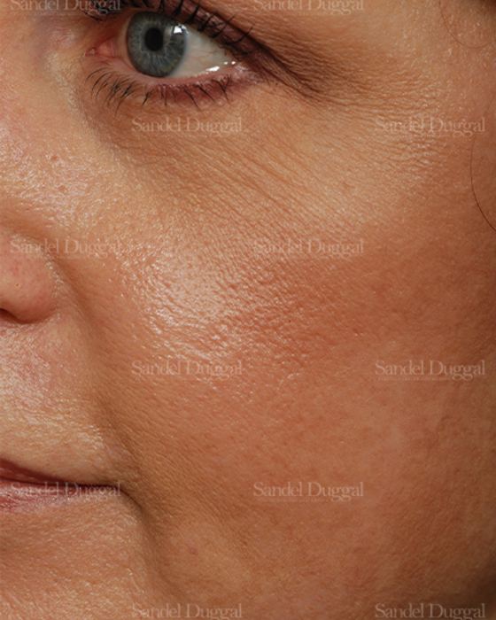 Laser Skin Resurfacing after, case 2923