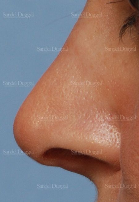 Revision Rhinoplasty after, case 2624