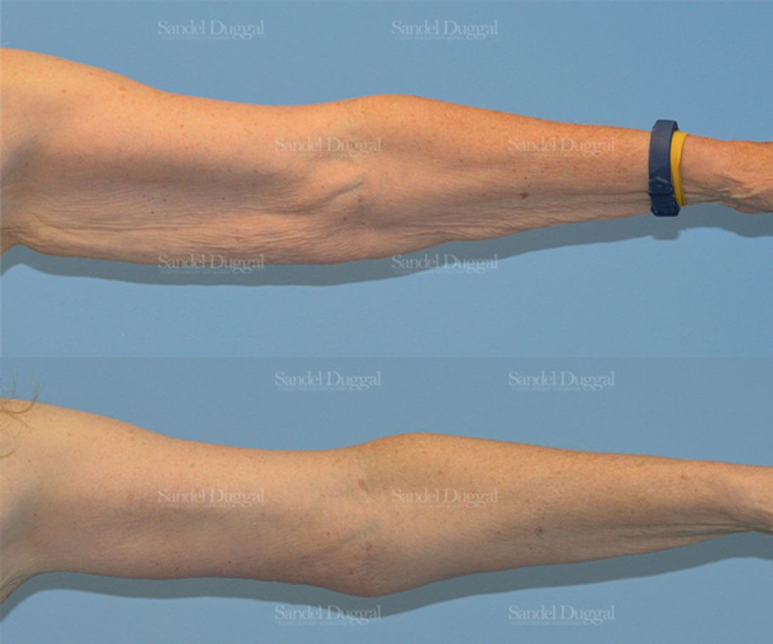 Brachioplasty before and after, case 2118