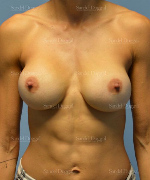 Breast Augmentation after, case 3150