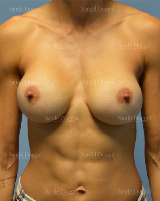 Breast Augmentation after, case 3150
