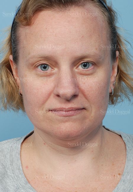 Rhinoplasty before, case 2862