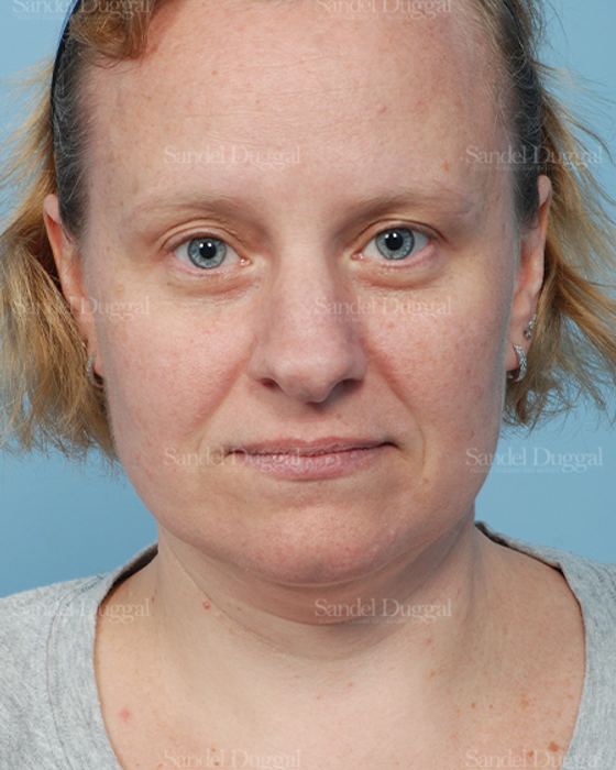 Rhinoplasty before, case 2862