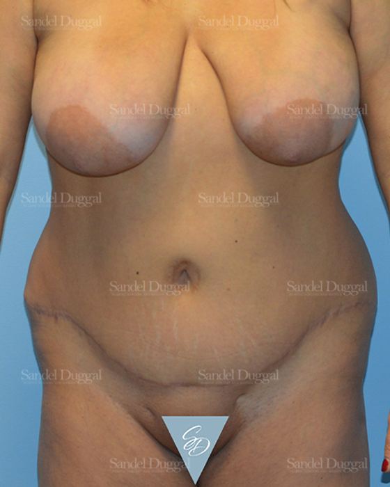 Liposuction — Abdomen before, case 2461