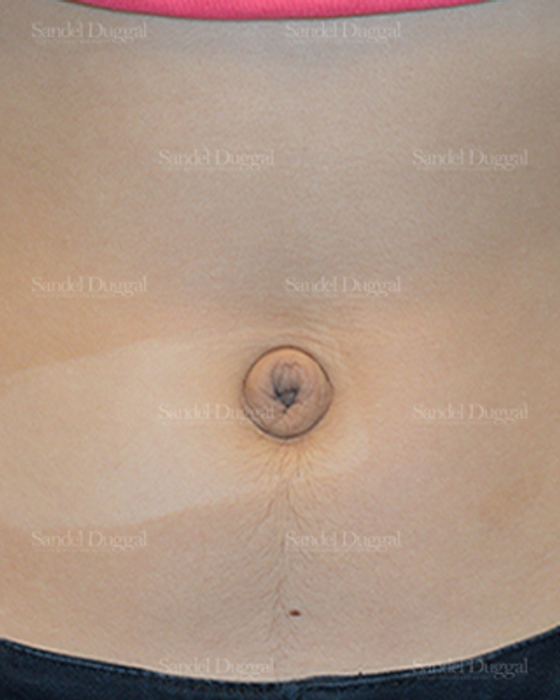 Umbilicoplasty before, case 1462