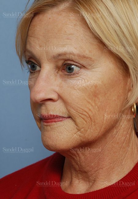 Laser Skin Resurfacing before, case 2692