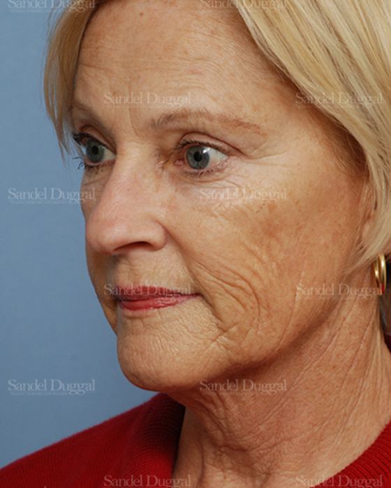 Laser Skin Resurfacing before, case 2692