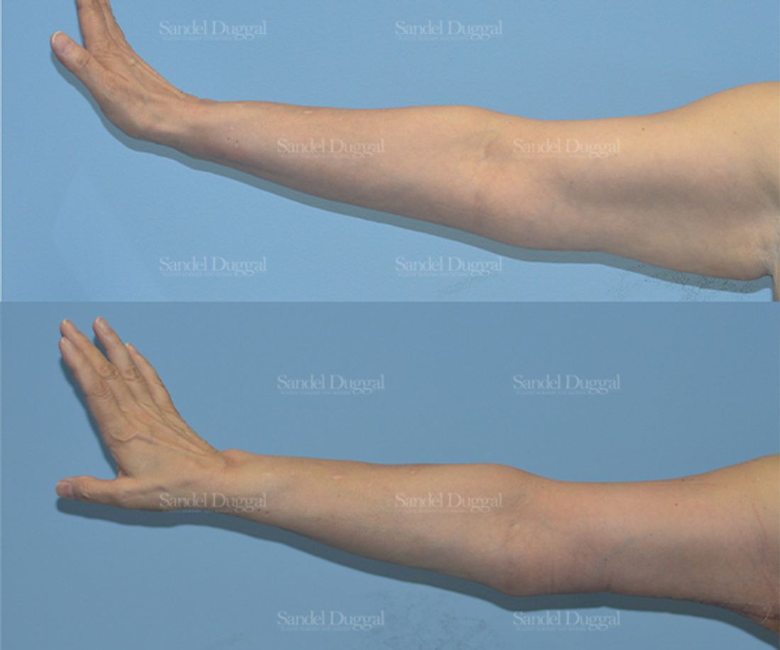 Brachioplasty before and after, case 2103