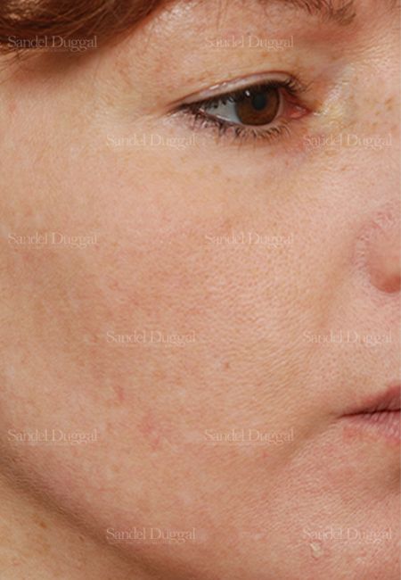 Laser Skin Resurfacing after, case 2986