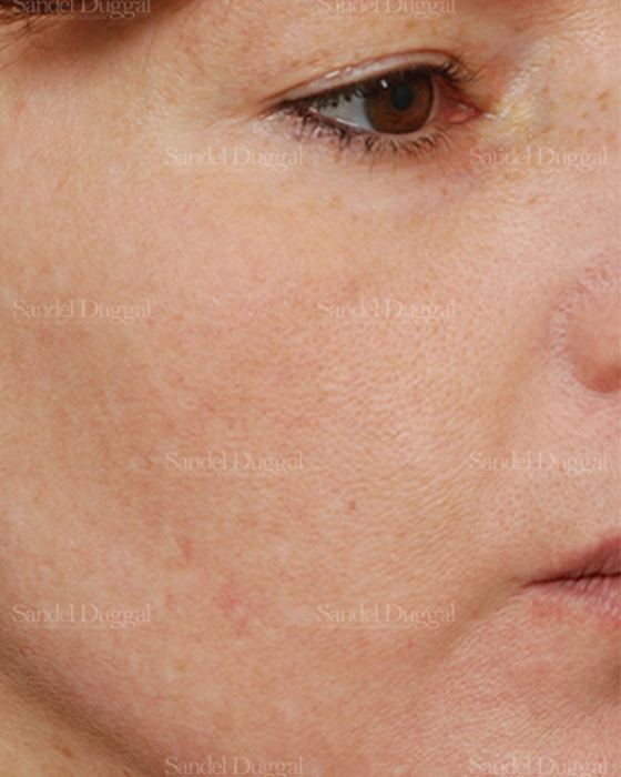 Laser Skin Resurfacing after, case 2986