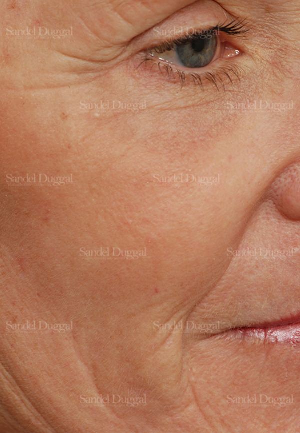 Laser Skin Resurfacing after, case 2972