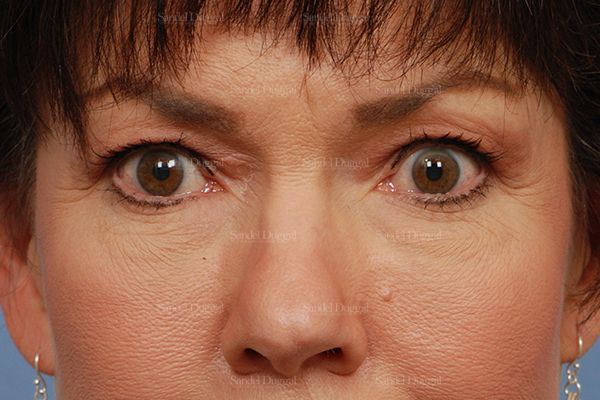 Eyelid Rejuvenation before, case 1971