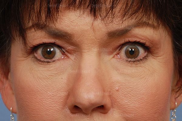 Eyelid Rejuvenation before, case 1971