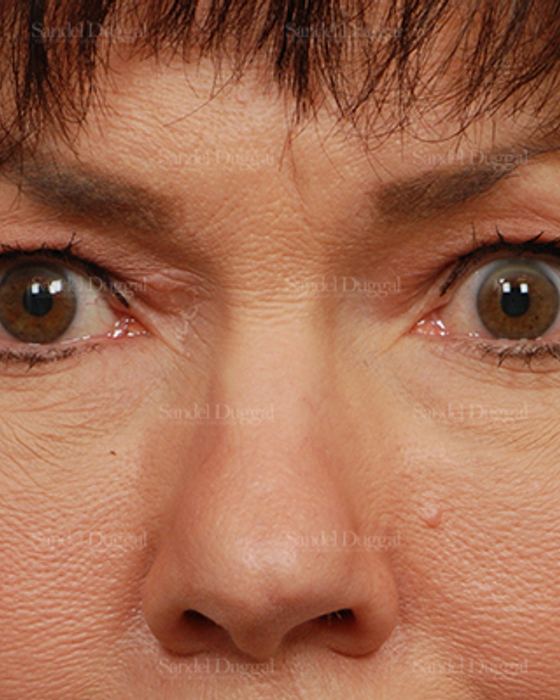 Eyelid Rejuvenation before, case 1971