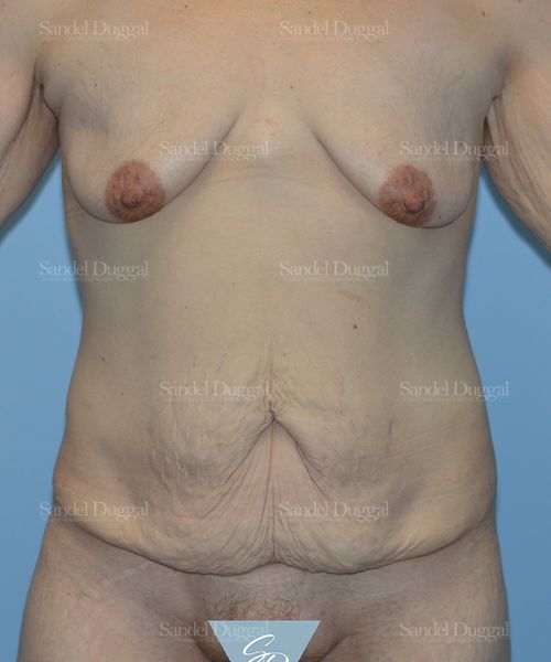Tummy Tuck before, case 1615