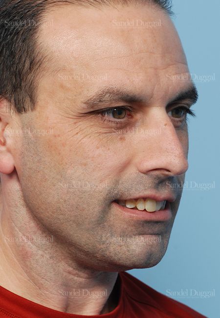 Rhinoplasty before, case 2909