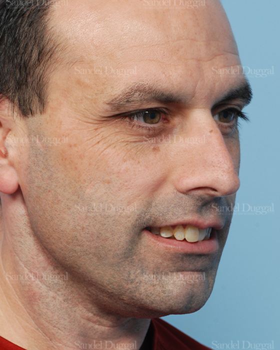 Rhinoplasty before, case 2909