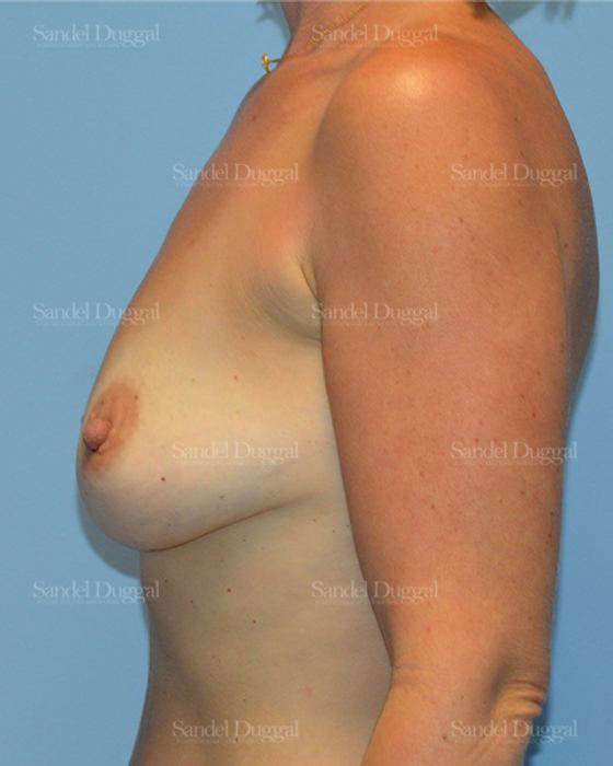Breast Augmentation before, case 3220