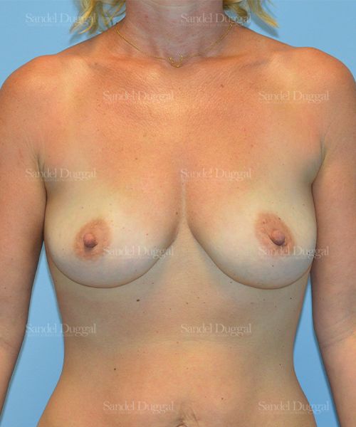 Breast Augmentation before, case 3220