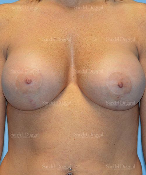 Breast Augmentation with Lift after, case 3435