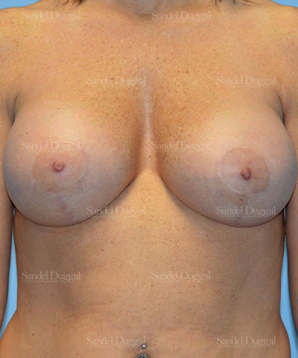 Breast Augmentation with Lift after, case 3435