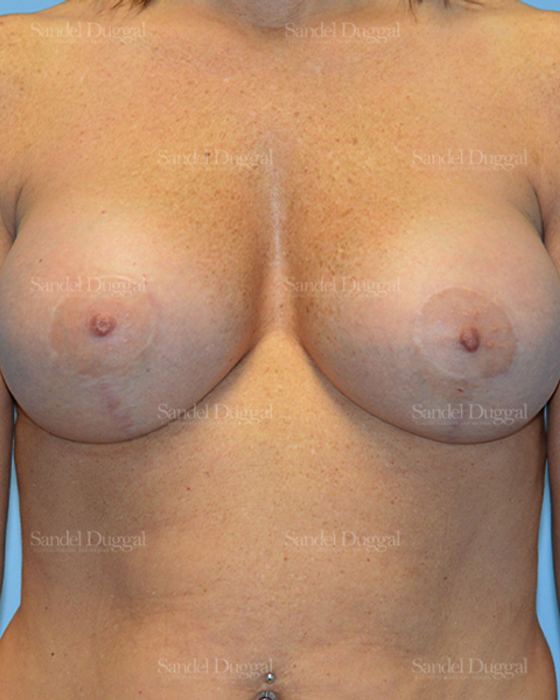 Breast Augmentation with Lift after, case 3435