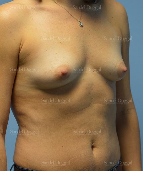 Breast Augmentation before, case 3213