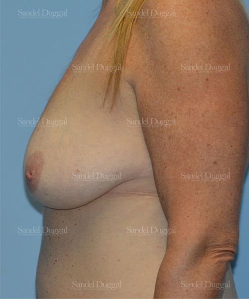 Breast Augmentation with Lift before, case 3442
