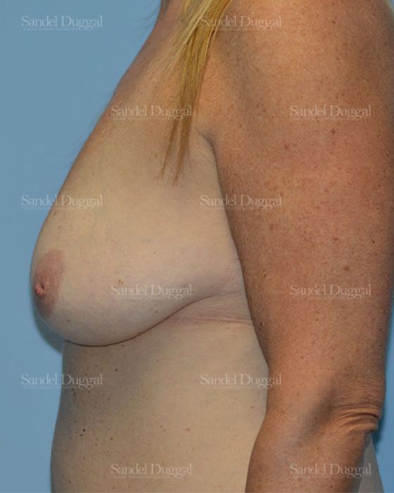 Breast Augmentation with Lift before, case 3442