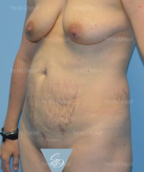 Tummy Tuck before, case 1659