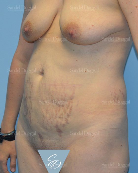 Tummy Tuck before, case 1659