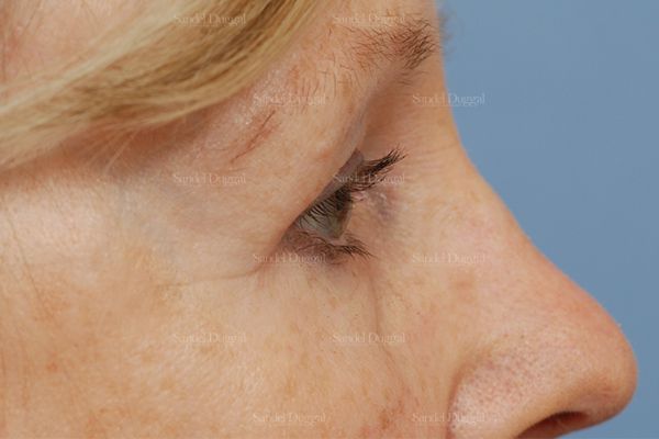 Eyelid Rejuvenation after, case 1940