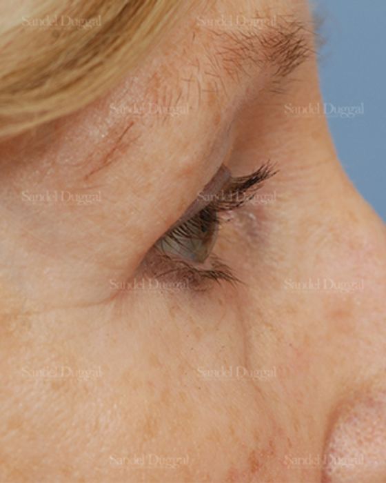 Eyelid Rejuvenation after, case 1940